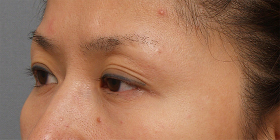 眼瞼下垂（がんけんかすい）,眼瞼下垂（がんけんかすい） 左目が三重になっていた30代女性の症例,Before,ba_ganken48_b.jpg
