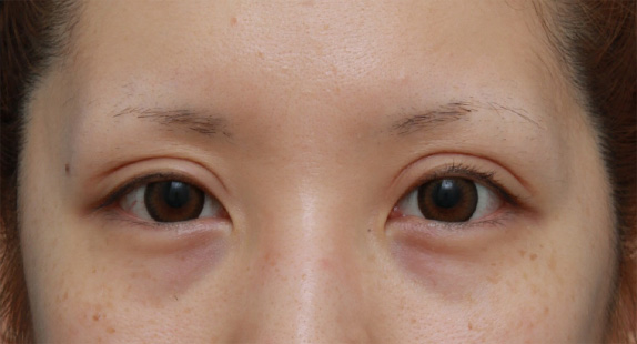 症例写真,他院で切開法で非常に幅の広い二重を作り失敗し、眼瞼下垂手術で幅を狭く修正した症例写真,After（4ヶ月後）,ba_ganken49_b.jpg