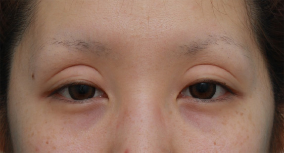 他院で切開法で非常に幅の広い二重を作り失敗し、眼瞼下垂手術で幅を狭く修正した症例写真,Before,ba_ganken49_b.jpg