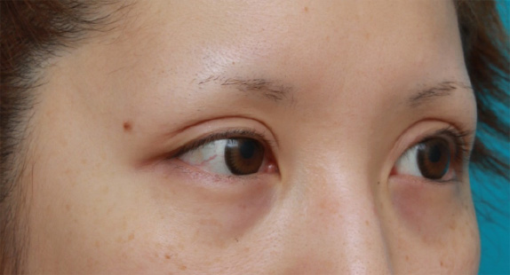 眼瞼下垂（がんけんかすい）,他院で切開法で非常に幅の広い二重を作り失敗し、眼瞼下垂手術で幅を狭く修正した症例写真,After（4ヶ月後）,ba_ganken50_b.jpg