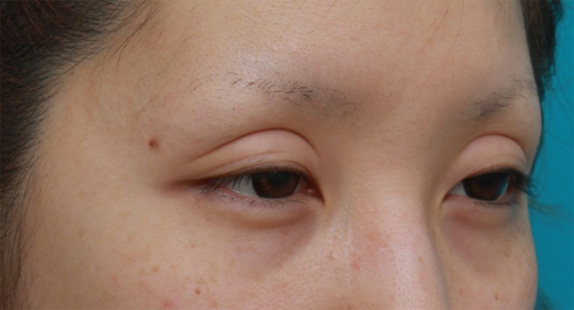 眼瞼下垂（がんけんかすい）,他院で切開法で非常に幅の広い二重を作り失敗し、眼瞼下垂手術で幅を狭く修正した症例写真,Before,ba_ganken50_b.jpg