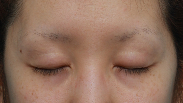 眼瞼下垂（がんけんかすい）,他院で切開法で非常に幅の広い二重を作り失敗し、眼瞼下垂手術で幅を狭く修正した症例写真,手術前,目を閉じた状態,mainpic_ganken11b.jpg