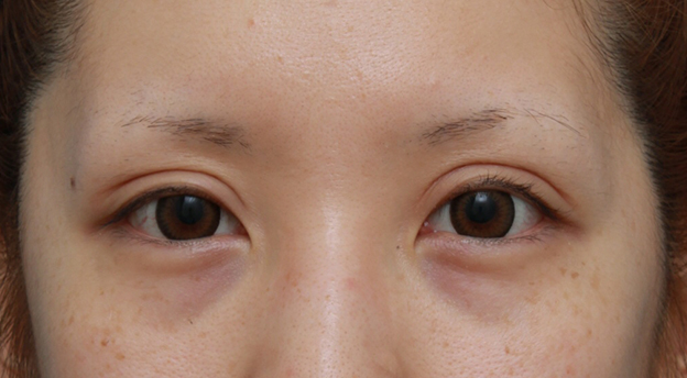 眼瞼下垂（がんけんかすい）,他院で切開法で非常に幅の広い二重を作り失敗し、眼瞼下垂手術で幅を狭く修正した症例写真,4ヶ月後,目を開けた状態,mainpic_ganken11f.jpg