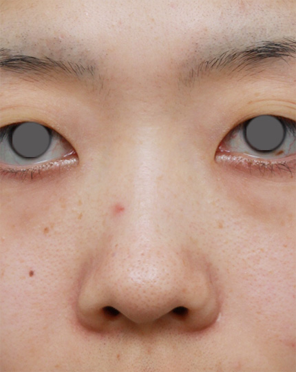 隆鼻術（シリコンプロテーゼ）,鼻プロテーゼ+鼻尖形成+鼻翼（小鼻）縮小症例写真,Before,ba_bisen16_b.jpg
