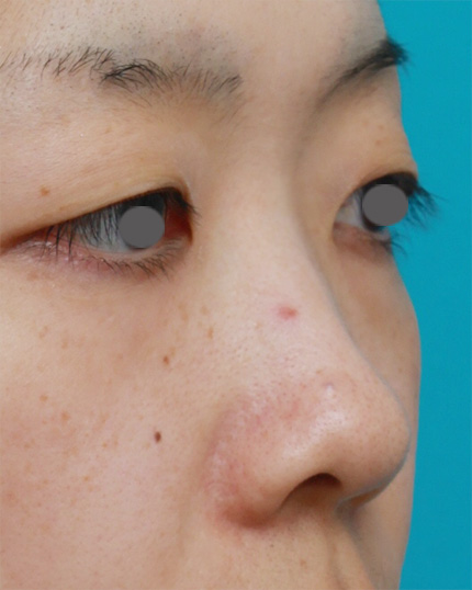 隆鼻術（シリコンプロテーゼ）,鼻プロテーゼ+鼻尖形成+鼻翼（小鼻）縮小症例写真,Before,ba_bisen17_b.jpg