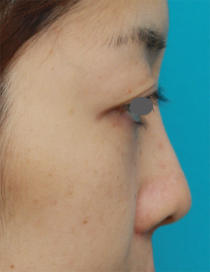 鼻翼縮小（小鼻縮小）,鼻プロテーゼ+鼻尖形成+鼻翼（小鼻）縮小症例写真,After,ba_bisen18_b.jpg