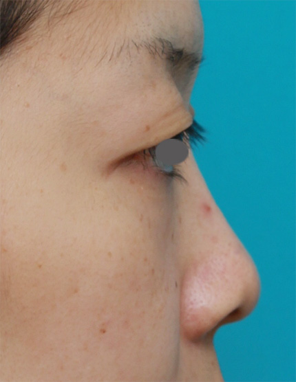 鼻翼縮小（小鼻縮小）,鼻プロテーゼ+鼻尖形成+鼻翼（小鼻）縮小症例写真,Before,ba_bisen18_b.jpg