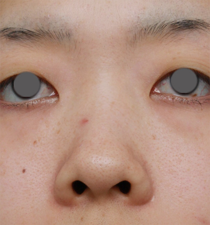 隆鼻術（シリコンプロテーゼ）,鼻プロテーゼ+鼻尖形成+鼻翼（小鼻）縮小症例写真,Before,ba_bisen19_b.jpg