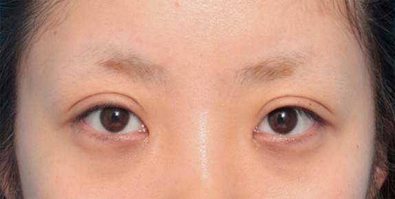 眼瞼下垂（がんけんかすい）,目頭切開+眼瞼下垂手術で小さい目を大きくした症例写真,After（メイクなし）,ba_ganken52_b.jpg