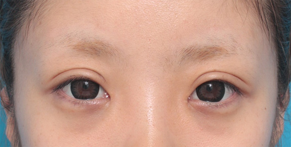 目頭切開,目頭切開+眼瞼下垂手術で小さい目を大きくした症例写真,After（カラコンあり）,