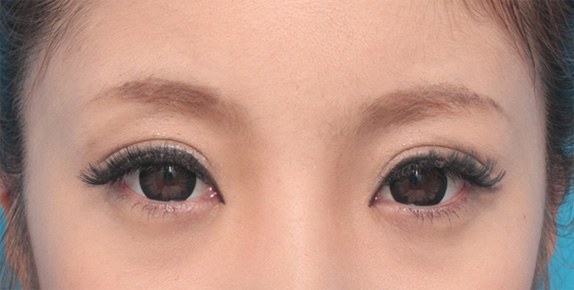 目頭切開,目頭切開+眼瞼下垂手術で小さい目を大きくした症例写真,After（カラコン、メイクあり）<br/>
（6ヶ月後）,