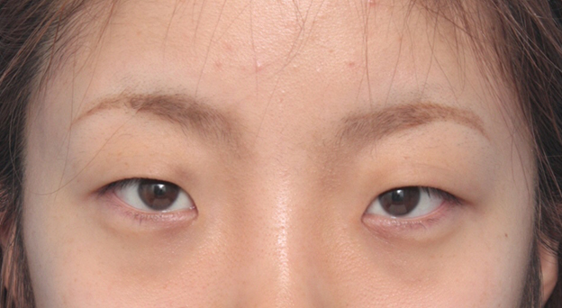 眼瞼下垂（がんけんかすい）,目頭切開+眼瞼下垂手術で小さい目を大きくした症例写真,手術前,mainpic_ganken12a.jpg