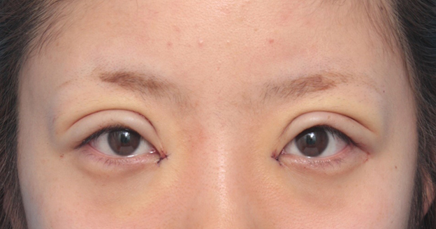 眼瞼下垂（がんけんかすい）,目頭切開+眼瞼下垂手術で小さい目を大きくした症例写真,手術直後,mainpic_ganken12b.jpg