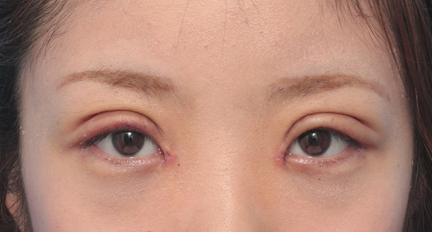 眼瞼下垂（がんけんかすい）,目頭切開+眼瞼下垂手術で小さい目を大きくした症例写真,1週間後,mainpic_ganken12c.jpg