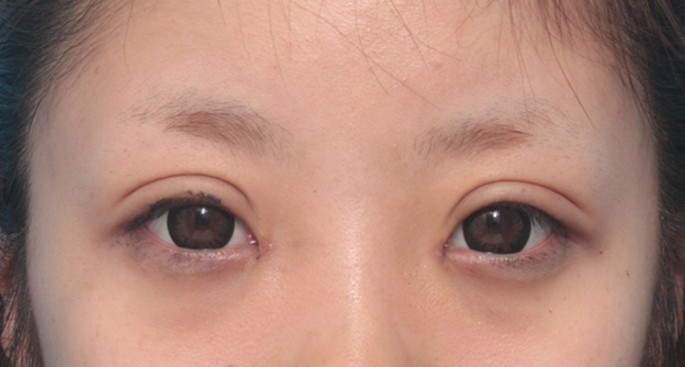 眼瞼下垂（がんけんかすい）,目頭切開+眼瞼下垂手術で小さい目を大きくした症例写真,1ヶ月後,mainpic_ganken12d.jpg