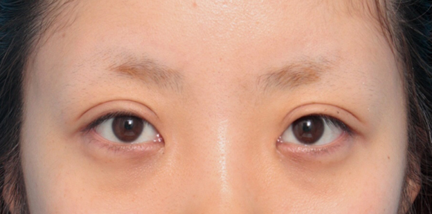 症例写真,目頭切開+眼瞼下垂手術で小さい目を大きくした症例写真,6ヶ月後,メイクなし,mainpic_ganken12e.jpg