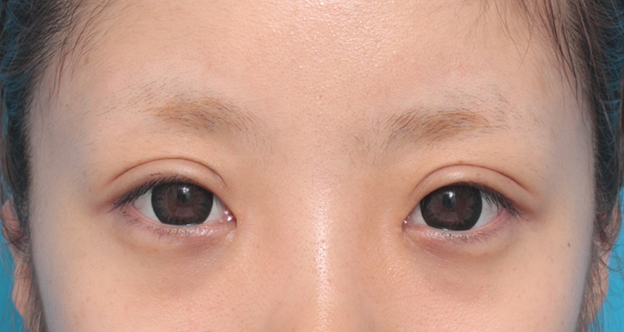 症例写真,目頭切開+眼瞼下垂手術で小さい目を大きくした症例写真,6ヶ月後,カラコンあり,mainpic_ganken12f.jpg