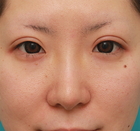 鼻先の皮膚の厚いダンゴ鼻に、鼻尖縮小+耳介軟骨移植をした症例写真の術前術後画像,After（6ヶ月後）,ba_bisen27_a01.jpg