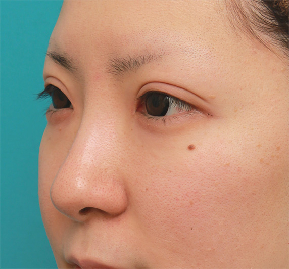 症例写真,鼻先の皮膚の厚いダンゴ鼻に、鼻尖縮小+耳介軟骨移植をした症例写真の術前術後画像,After（6ヶ月後）,ba_bisen28_b.jpg