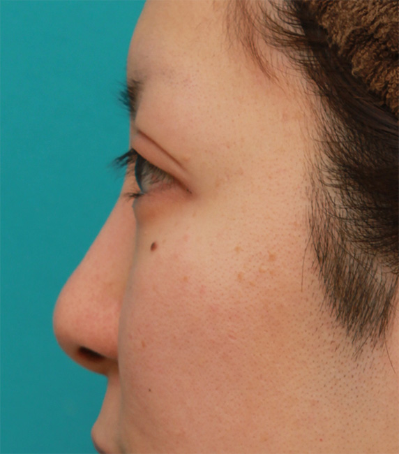 耳介軟骨移植（鼻先を出す）,鼻先の皮膚の厚いダンゴ鼻に、鼻尖縮小+耳介軟骨移植をした症例写真の術前術後画像,Before,ba_bisen29_b.jpg