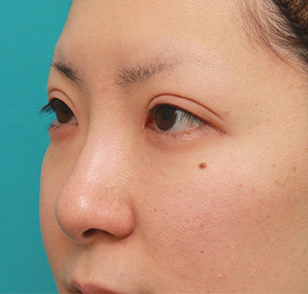 症例写真,鼻先の皮膚の厚いダンゴ鼻に、鼻尖縮小+耳介軟骨移植をした症例写真の術前術後画像,手術前,mainpic_bisen02i.jpg