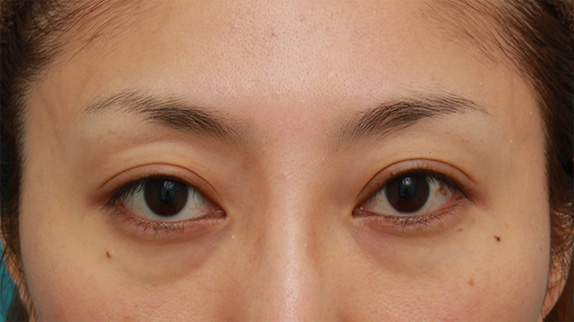 開きに左右差がある眼瞼下垂を手術で修正した30代女性の症例写真,After（4ヶ月後）,ba_ganken53_a01.jpg