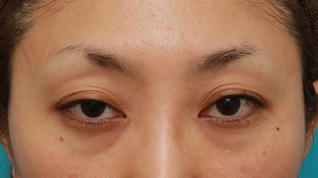 眼瞼下垂（がんけんかすい）,開きに左右差がある眼瞼下垂を手術で修正した30代女性の症例写真,手術前,mainpic_ganken13a.jpg