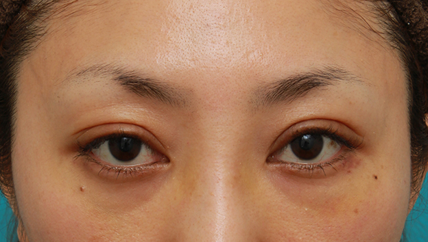 眼瞼下垂（がんけんかすい）,開きに左右差がある眼瞼下垂を手術で修正した30代女性の症例写真,1週間後,mainpic_ganken13c.jpg