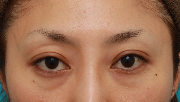 症例写真,開きに左右差がある眼瞼下垂を手術で修正した30代女性の症例写真,1ヶ月後,mainpic_ganken13d.jpg