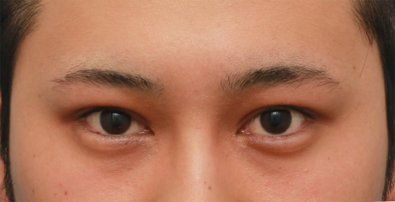 眼瞼下垂（がんけんかすい）,片目の眼瞼下垂を手術で治し、ほぼ左右対称にした症例写真,After（8ヶ月後）,ba_ganken54_b.jpg