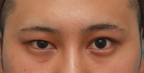 眼瞼下垂（がんけんかすい）,片目の眼瞼下垂を手術で治し、ほぼ左右対称にした症例写真,Before,ba_ganken54_b.jpg