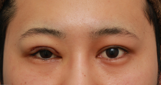 眼瞼下垂（がんけんかすい）,片目の眼瞼下垂を手術で治し、ほぼ左右対称にした症例写真,手術直後,mainpic_ganken14b.jpg