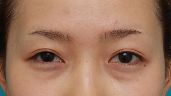 眼瞼下垂（がんけんかすい）,先天性と思われる片目の眼瞼下垂を修正し、反対の目は二重まぶた全切開法をした症例写真の術前術後画像,After（目を開けた状態）,ba_ganken55_b.jpg