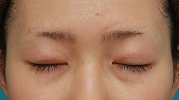眼瞼下垂（がんけんかすい）,先天性と思われる片目の眼瞼下垂を修正し、反対の目は二重まぶた全切開法をした症例写真の術前術後画像,After（目を閉じた状態）<br/>
（6ヶ月後）,