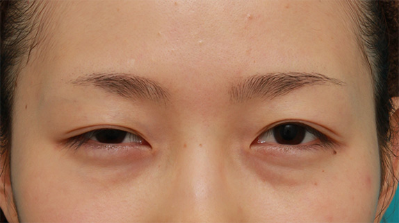 眼瞼下垂（がんけんかすい）,先天性と思われる片目の眼瞼下垂を修正し、反対の目は二重まぶた全切開法をした症例写真の術前術後画像,Before,ba_ganken55_b.jpg