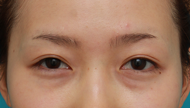 眼瞼下垂（がんけんかすい）,先天性と思われる片目の眼瞼下垂を修正し、反対の目は二重まぶた全切開法をした症例写真の術前術後画像,6ヶ月後,目を開けた状態,n1elc60000002mii.jpg