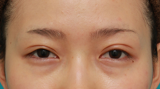 眼瞼下垂（がんけんかすい）,先天性と思われる片目の眼瞼下垂を修正し、反対の目は二重まぶた全切開法をした症例写真の術前術後画像,1ヶ月後,目を開けた状態,n1elc60000002miy.jpg