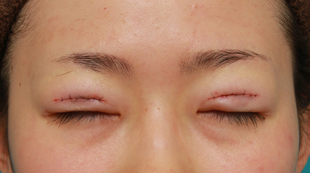 眼瞼下垂（がんけんかすい）,先天性と思われる片目の眼瞼下垂を修正し、反対の目は二重まぶた全切開法をした症例写真の術前術後画像,手術直後,目を閉じた状態,n1elc60000002mjm.jpg