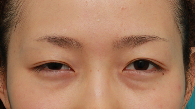 眼瞼下垂（がんけんかすい）,先天性と思われる片目の眼瞼下垂を修正し、反対の目は二重まぶた全切開法をした症例写真の術前術後画像,手術前,n1elc60000002mk2.jpg