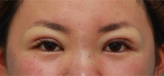 眼瞼下垂（がんけんかすい）,眼瞼下垂手術で眠たそうなまぶたの開きを良くし、同時に一重を二重にした20代女性の症例写真の術前術後画像,手術直後,mainpic_ganken16b.jpg