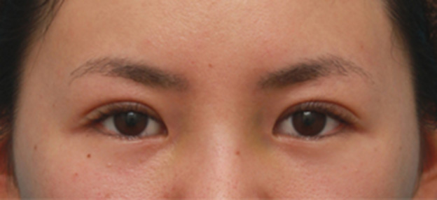 眼瞼下垂（がんけんかすい）,眼瞼下垂手術で眠たそうなまぶたの開きを良くし、同時に一重を二重にした20代女性の症例写真の術前術後画像,1週間後,mainpic_ganken16c.jpg