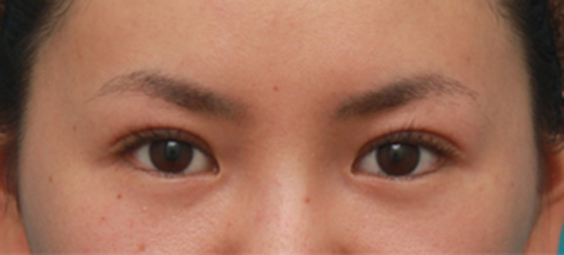 眼瞼下垂（がんけんかすい）,眼瞼下垂手術で眠たそうなまぶたの開きを良くし、同時に一重を二重にした20代女性の症例写真の術前術後画像,1ヶ月後,mainpic_ganken16d.jpg