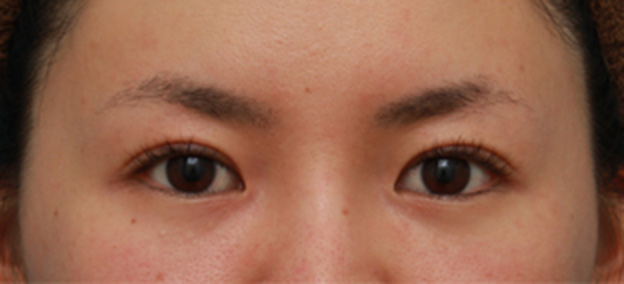 眼瞼下垂（がんけんかすい）,眼瞼下垂手術で眠たそうなまぶたの開きを良くし、同時に一重を二重にした20代女性の症例写真の術前術後画像,3ヶ月後,mainpic_ganken16e.jpg
