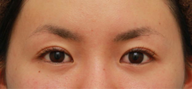 眼瞼下垂（がんけんかすい）,眼瞼下垂手術で眠たそうなまぶたの開きを良くし、同時に一重を二重にした20代女性の症例写真の術前術後画像,6ヶ月後,mainpic_ganken16f.jpg