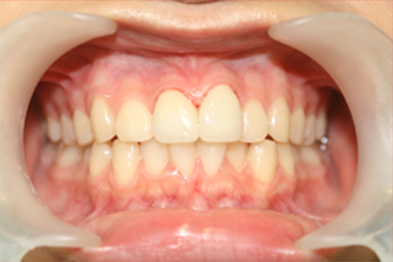 症例写真,オールセラミッククラウン（e-max）の症例写真 出っ歯を少ない本数できれいに,After,ba_ceramic05_b.jpg