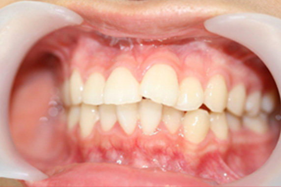 オールセラミッククラウン（e-max）,オールセラミッククラウン（e-max）の症例写真 出っ歯を少ない本数できれいに,Before,ba_ceramic05_b.jpg