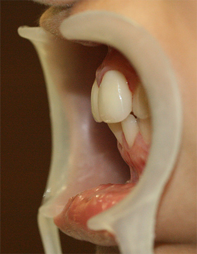 症例写真,オールセラミッククラウン（e-max）の症例写真 出っ歯を少ない本数できれいに,After,ba_ceramic62_b.jpg