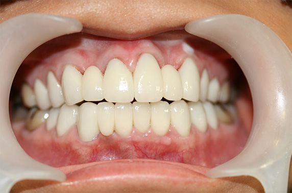 オールセラミッククラウン（e-max）,オールセラミッククラウン（e-max）の症例写真 歯の色と歯並びを短期間・少回数で,After,ba_ceramic06_b.jpg