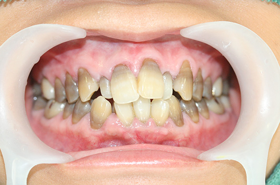 症例写真,オールセラミッククラウン（e-max）の症例写真 歯の色と歯並びを短期間・少回数で,Before,ba_ceramic06_b.jpg
