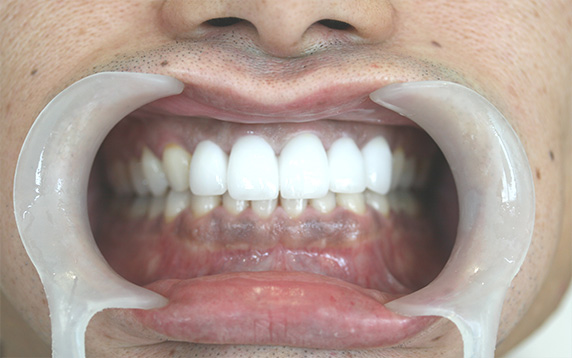 オールセラミッククラウン（e-max）の症例写真 今よりもっと白く大きな歯に,After,ba_ceramic08_a01.jpg